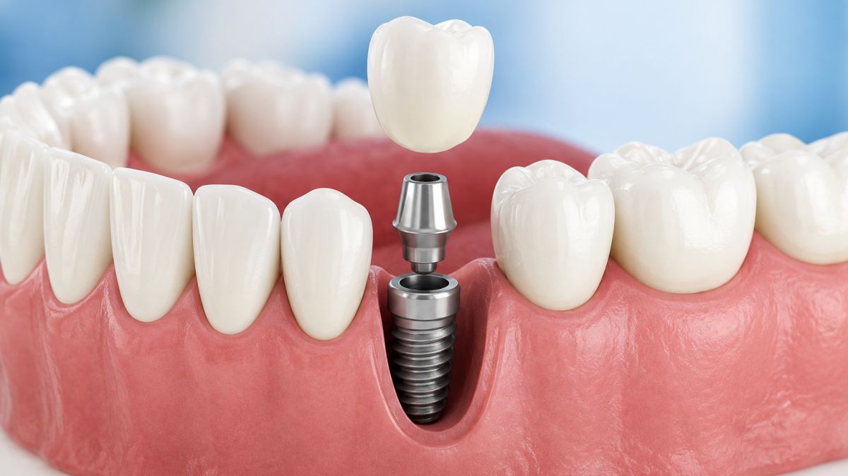 Dental implant treatment Pune,  missing tooth replacement Pune,  single tooth implants Pune,  full mouth dental implants Pune,  implant supported teeth Pune,  advanced dental implant clinic Pune,  permanent tooth replacement Pune,  natural looking dental implants Pune,  dental restoration Pune,  Dr Hileri Mori Pune dentist