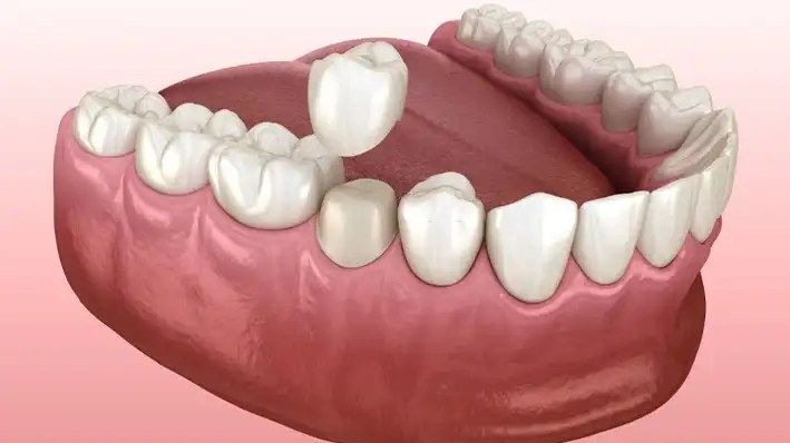 full mouth implant cost Pune,  full mouth dental implants Pune,  full mouth implants Pune,  dental implant cost Pune,  full mouth teeth replacement Pune,  full arch dental implants Pune,  dental implants Pune,  implant dentist Pune,  full mouth rehabilitation Pune,  Dr. Hileri Mori