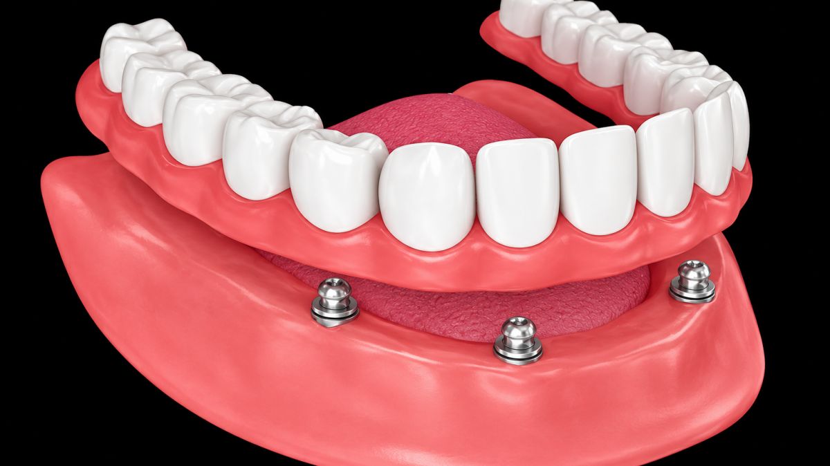 Teeth Replacement Treatment Pune,  denture free dental treatment,  fixed tooth replacement Pune,  missing tooth replacement Pune,  implant supported teeth Pune,  natural looking replacement teeth,  permanent tooth replacement,  full mouth teeth replacement Pune,  advanced dental implants Pune,  teeth restoration specialist Pune